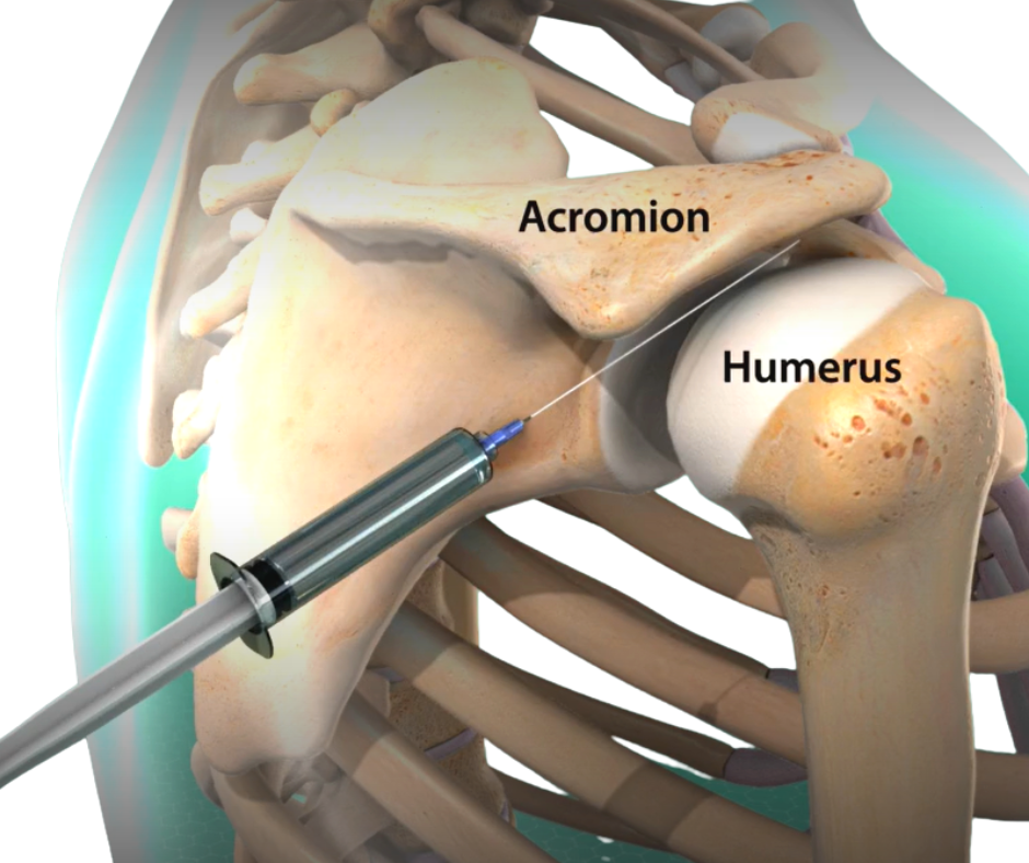 Periarticular Injection